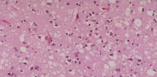 New Hampshire Patient Died of Rare Brain Disease, More Exposed cjd cells