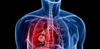 Personalized Medicine Gives New Hope to Lung Cancer Patients lung cancer