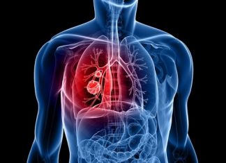 Personalized Medicine Gives New Hope to Lung Cancer Patients lung cancer