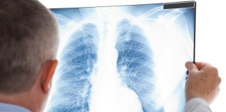 Lung Cancer Screenings Increase Five-Year Survival Rate by 73% Lung Cancer Screenings