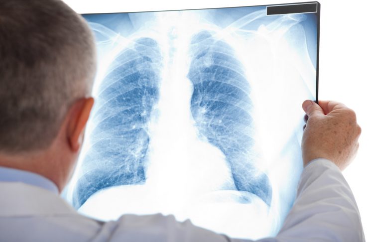 Lung Cancer Screenings Increase Five-Year Survival Rate by 73% Lung Cancer Screenings